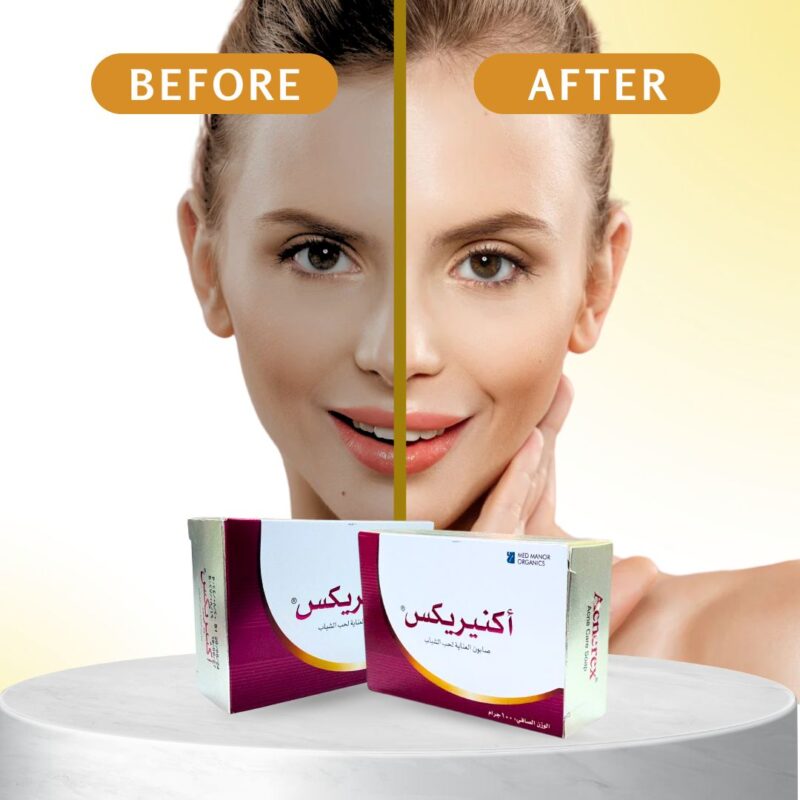 ORIGINAL Acnerex Acne Care Soap 100g - Image 2